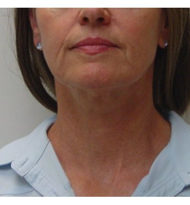facelift with natural results